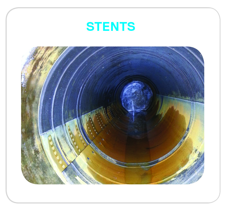 CUES LOCK Stents